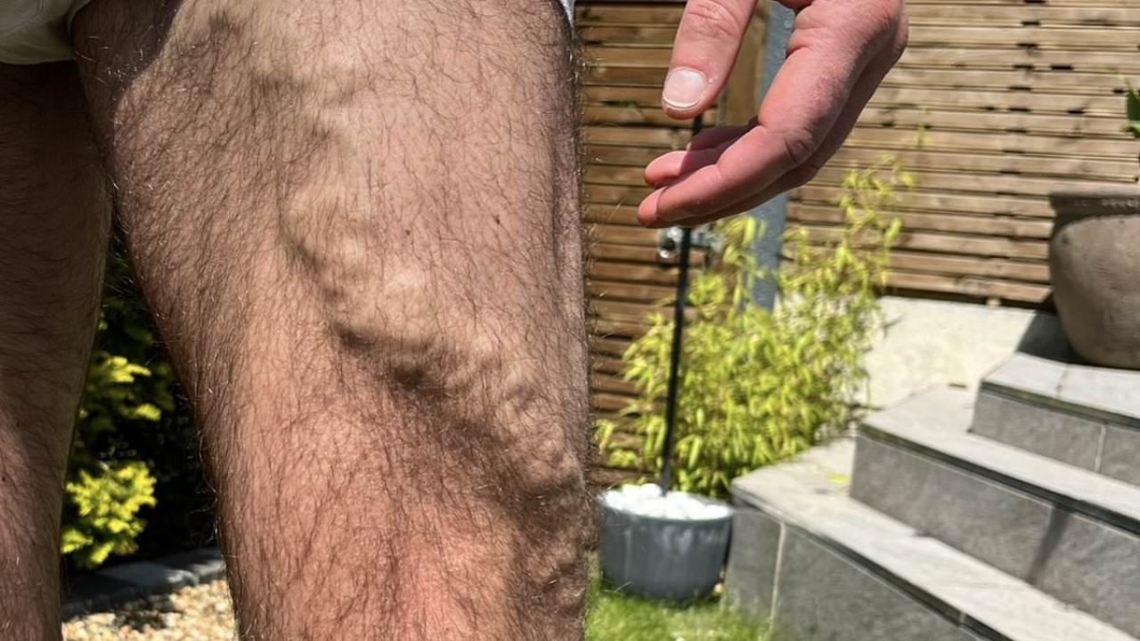 What can I do about the ugly, lumpy veins in my legs?