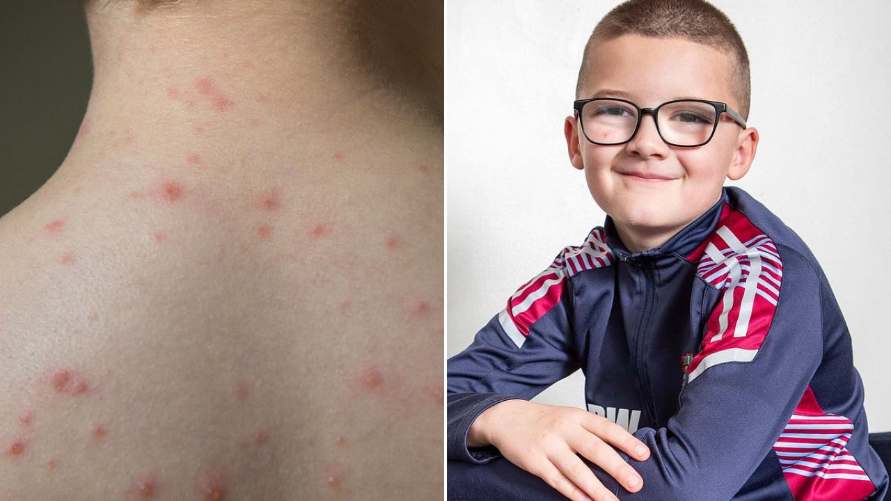 The chickenpox complication that left Roman in a wheelchair aged four