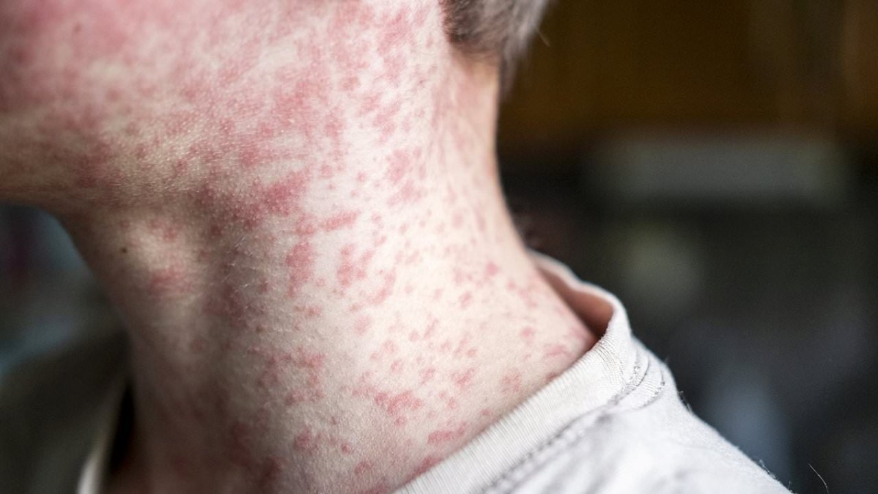 Terrifying measles side effect lurking in kids and killing years later