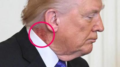 Trump’ın Boynundaki İz Spekülasyonlara Neden Oldu: Beyaz Saray Açıklama Yaptı