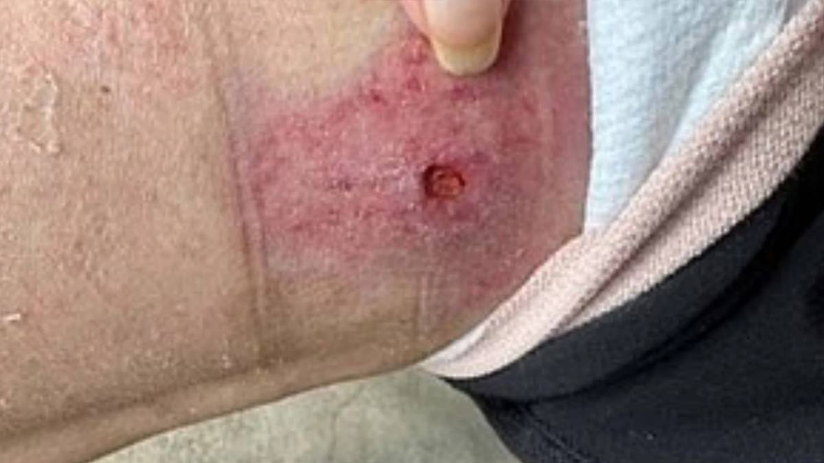 Grip sandı, 'et yiyen bakteri' çıktı! 17 ameliyatla hayata tutundu